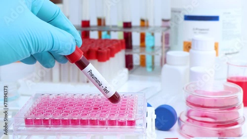 Pneumonia test to look for abnormalities from blood, scientific experiment