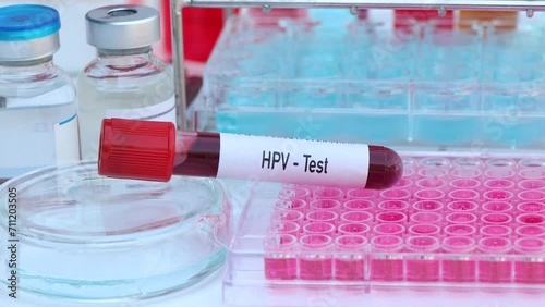 HPV test to look for abnormalities from blood, scientific experiment