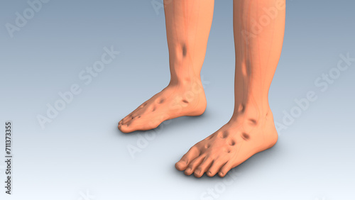 Leg swelling or lower limb edema photo