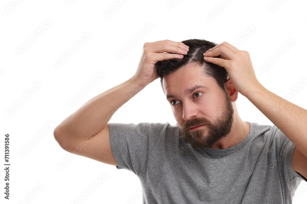 Man with dandruff in his dark hair on white background Man with dandruff in his dark hair on white background