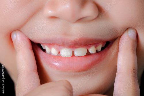 Close-up of a cute Asian girl pointing her finger at the corner of her mouth and smiling happily showing her front teeth. Happy life concept