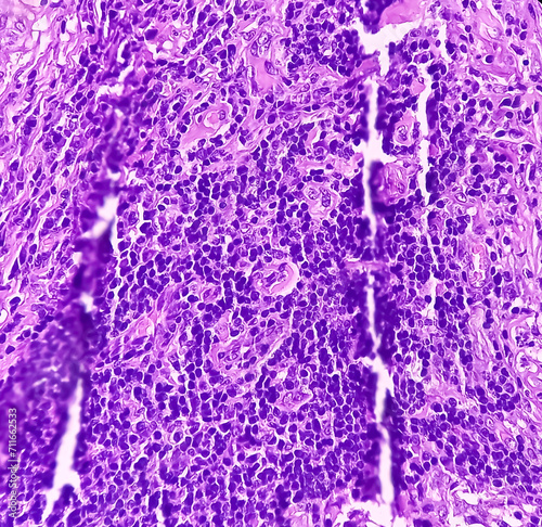 Thyroid cancer: Microscopic image of Follicular neoplasm. Malignant neoplasm of atypical thyroid follicular epithelial cells. Some of cells show pleomorphism with nuclear grooving. Nodular goiter. photo