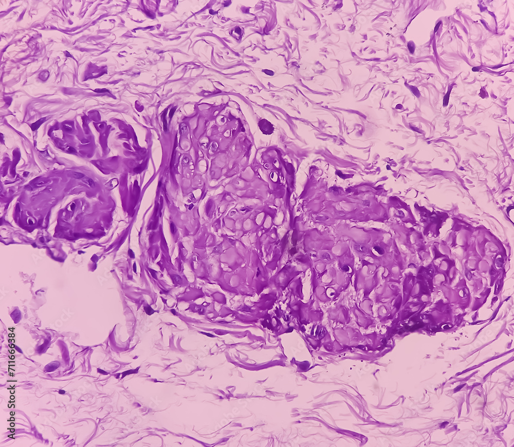 Obraz premium Prostatic Tissue (biopsy): Sections show show fatty tissue, neural tissue and muscle tissue. Prostate cancer diagnosis.