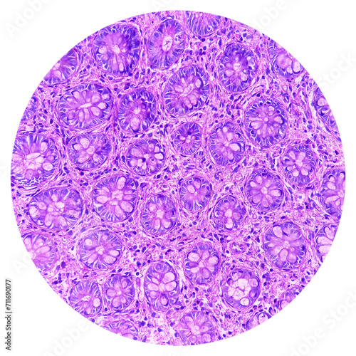 Ileo-cecal ulcer (biopsy): Chronic nonspecific ileitis with ulcer. Section show ileal mucosa, dense infiltration of lymphocytes, histiocytes, plasma cell in lamina propria. IBD. photo