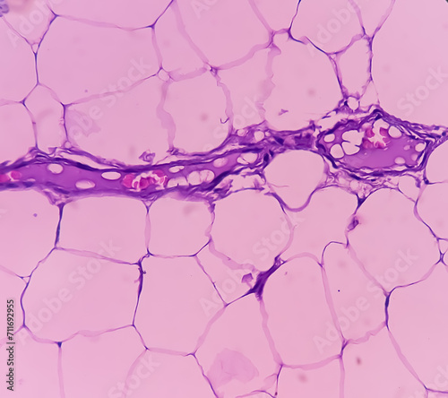 Lipoma on cubital fossa, benign growth of fatty tissue, benign neoplasm, adipocytes, partially capsulated tumor, 40x microscopic view. photo