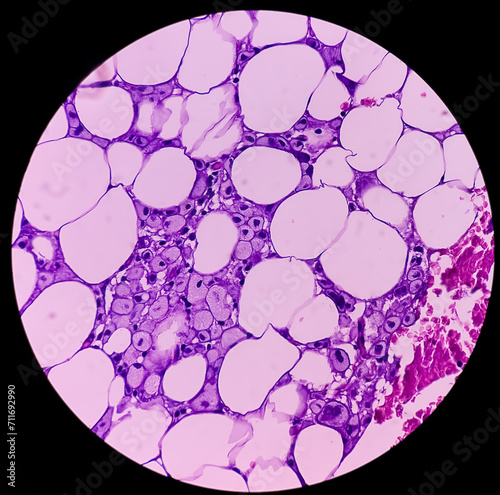 Lipoma on cubital fossa, benign growth of fatty tissue, benign neoplasm, adipocytes, partially capsulated tumor, 40x microscopic view. photo