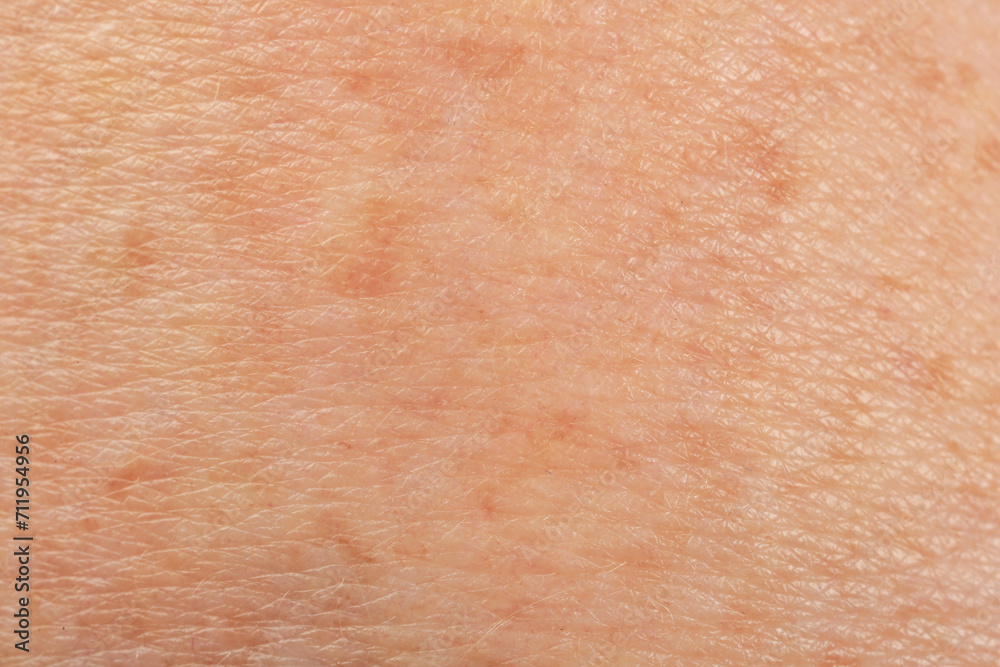 Fototapeta premium Texture of skin with pigmentation as background, macro view