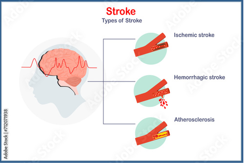 Medical vector illustration in flat style. Concept of types of stroke, ischemic, hemorrhagic and atherosclerosis.