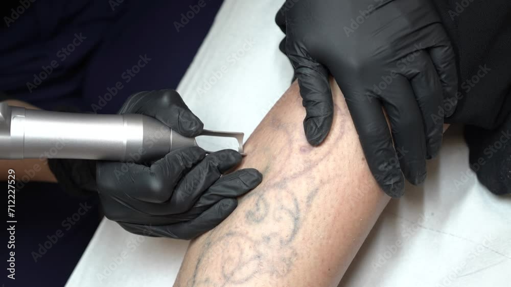 toma detalle de eliminación laser de un tatuaje