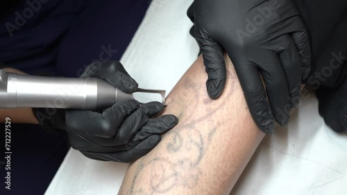 toma detalle de eliminación laser de un tatuaje photo