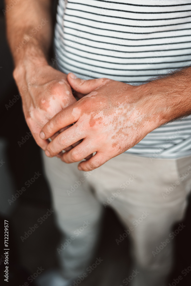 Vitiligo Hands. Close-Up on a Male with skin pigmentation Vitiligo Hands. Close-Up on a Male with skin pigmentation