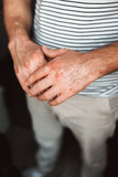 Vitiligo Hands. Close-Up on a Male with skin pigmentation