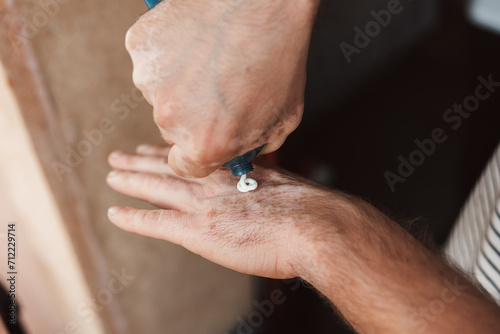 Vitiligo Care. Gentle Hands Applying Treatment for Skin Condition photo