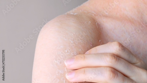 Skin is peeling shoulder with peeling skin close-up front view skin problems dry skin consequences of dehydration and dermatitis self care  concept of body and cosmetology hygiene and medicine