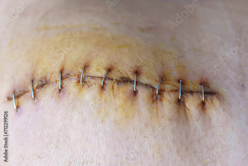 The surgical wound around the knee was sutured with staples. photo