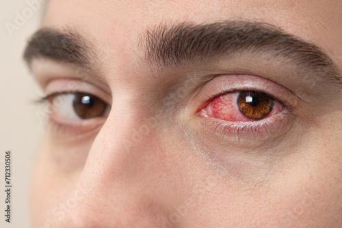 Photos Close Up of Severe Bloodshot Red Blood Eye of Male Affected by Conjunctivitis or After Allergy