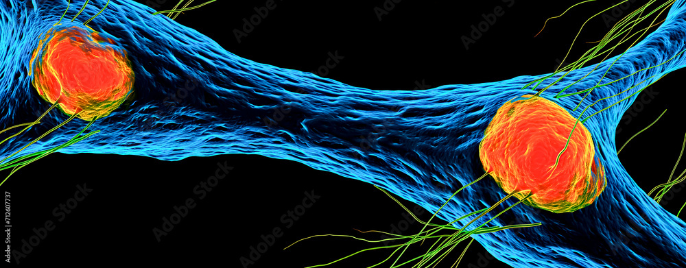 Two human tumor cells photographed with a fluorescence microscope ...