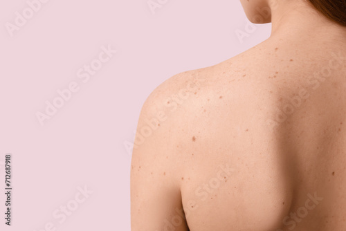 Young woman with moles on pink background, back view photo
