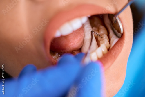 Close up of woman during teeth check-up at dentist's office. © Drazen