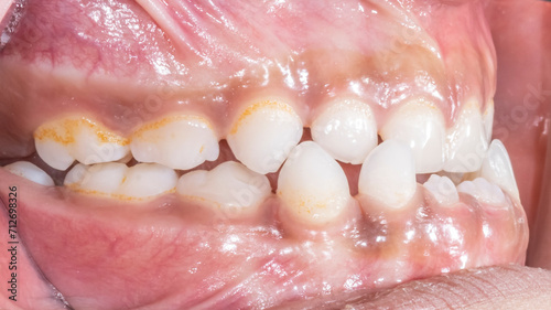 Dentistry clinical case of a young kid with a skeletal Class III malocclusion anterior crossbite, side view of mandibular and maxillary arches biting deciduous teeth and permanent incisors erupting  photo