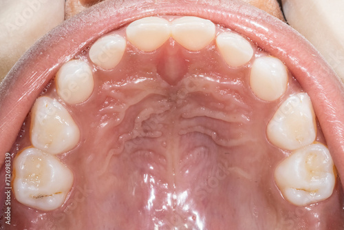 Upper maxillary arch occlusal view of a eight year old child dentition. Healthy gingival gum, palate, teeth aligned and no decay. Directly below view with mirror medical photography. 