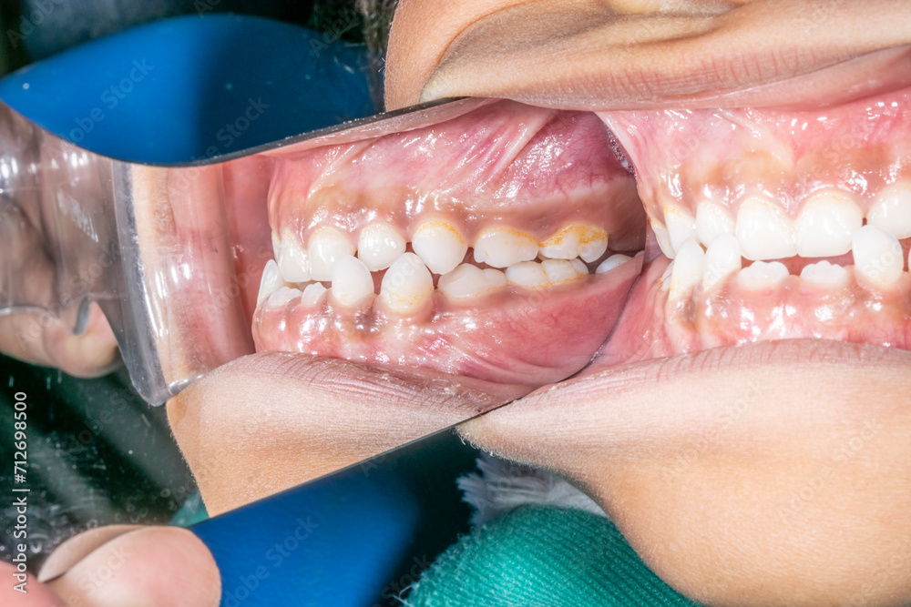 Dentistry clinical case of a biting child with class III orthodontic malocclusion, side view of mandibular and maxillary arches biting teeth indirect mirror view reflected