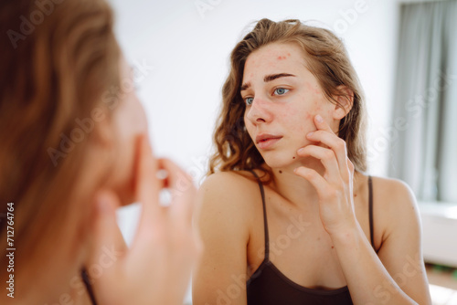 Skin Problem. Depressed Woman Touching Pimple On Face Looking At Mirror. Allergic reaction from cosmetic, red spot or rash on face. Beauty care.