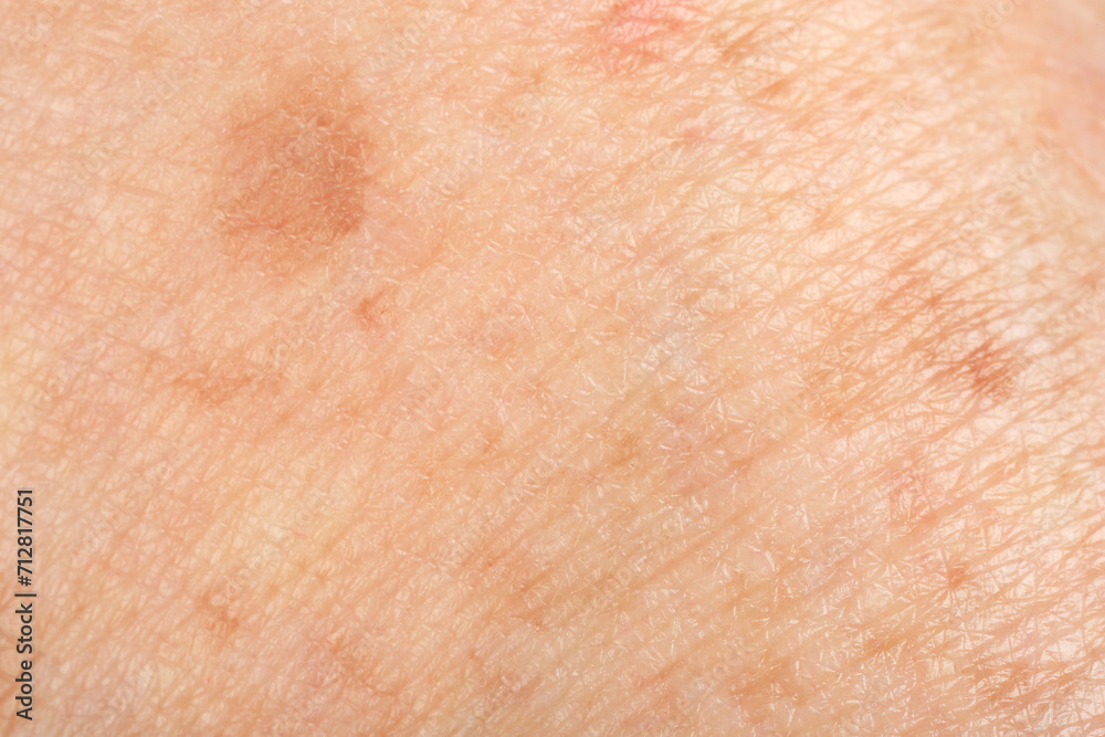 Fototapeta premium Texture of skin with pigmentation as background, macro view