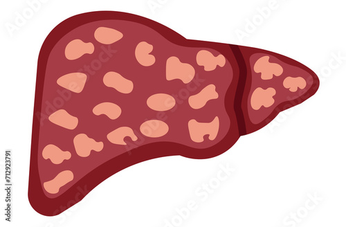 liver, cirrhosis disease. Human liver organ anatomy vector illustration on white background.Stage Of liver Disease Concept,Unhealthy Liver,Cirrhosis Medical Education,sad,red,yellow