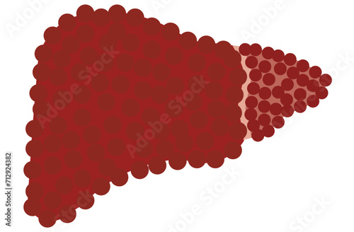 liver, cirrhosis disease. Human liver organ anatomy vector illustration on white background.Stage Of liver Disease Concept,Unhealthy Liver,Cirrhosis Medical Education,sad,red,yellow