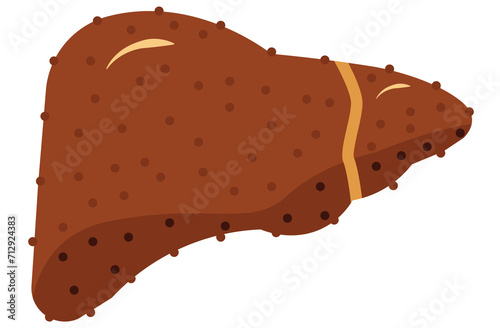 liver, cirrhosis disease. Human liver organ anatomy vector illustration on white background.Stage Of liver Disease Concept,Unhealthy Liver,Cirrhosis Medical Education,sad,red,yellow