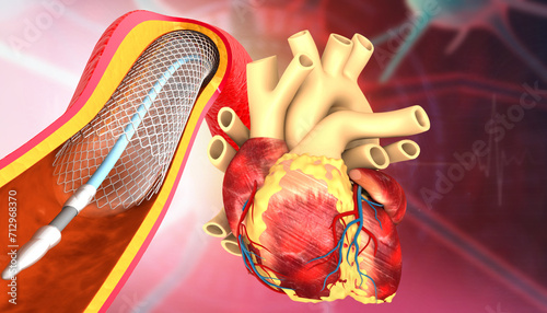 Human heart with angioplasty, stent implant. 3d illustration. photo