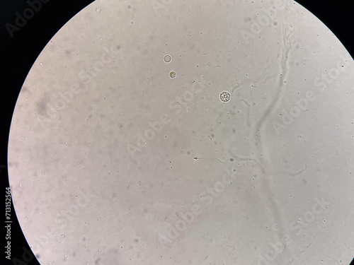 Fresh spermatozoa in urine. photo