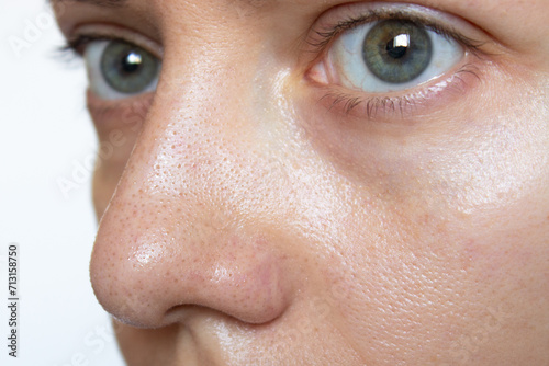 Close-up of a young woman's face with sweat and oily shine on her nose and cheeks. Large enlarged pores and blackheads on the skin of the face. Comedones, acne, hyperhidrosis. Facial skin problems photo