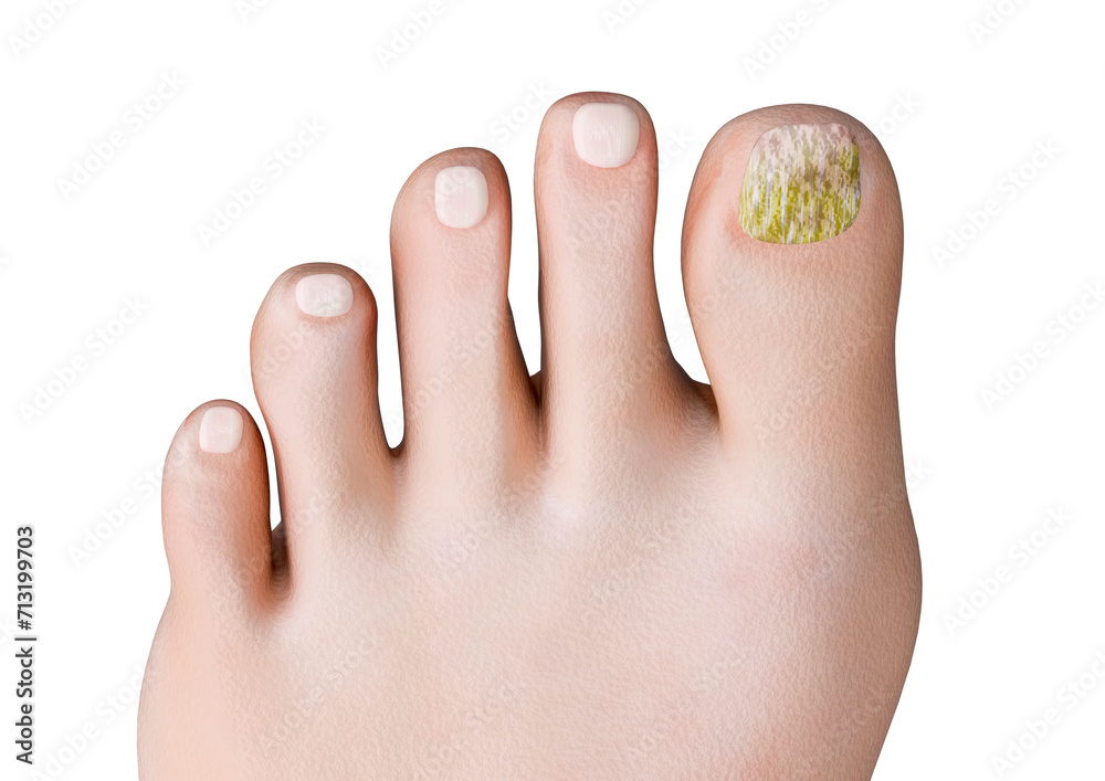 Onychomycosis is a nail infection caused by fungi, which feed on