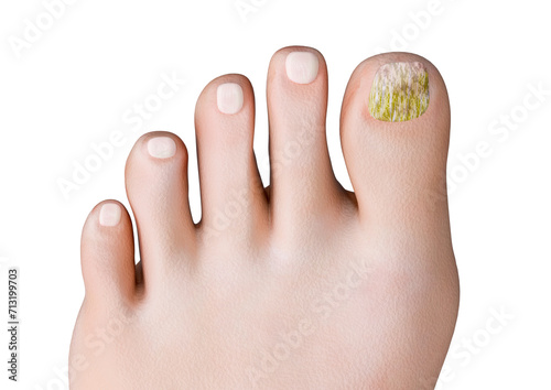 Onychomycosis is a nail infection caused by fungi, which feed on keratin, the protein that makes up most of the nails
