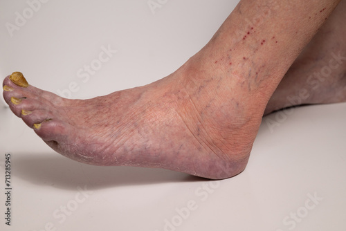 Closeup of a elderly woman foot with damaged nails because of fungus.Varicose veins on the womans legs photo