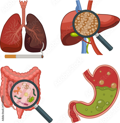Anatomy of Human Organs with Various Diseases. Vector Illustration of Smoker's Lungs, Liver Hepatitis, Intestinal Virus, and Indigestion. Medicine Concept