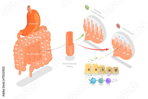 3D Isometric Flat  Conceptual Illustration of Celiac Disease, Educational Diagram photo