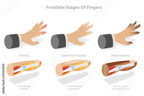 3D Isometric Flat  Conceptual Illustration of Frostbite Stages Of Fingers, Frozen Hands