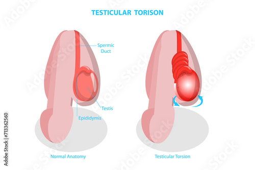 3D Isometric Flat  Conceptual Illustration of Testicular Torison, Male Reproductive System Disorder photo