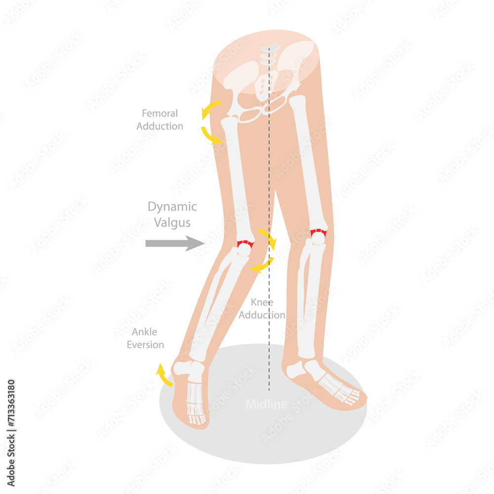 3D Isometric Flat Conceptual Illustration of Mechanism Of Acl Injury ...
