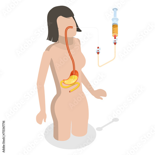 3D Isometric Flat  Conceptual Illustration of PEG, Nasogastric Tube Passed Through the Nose to Stomach photo
