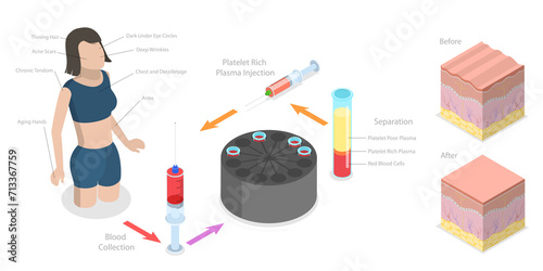 3D Isometric Flat Conceptual Illustration of PRP Procedure, Women Beauty and Skincare