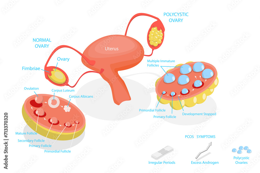 3D Isometric Flat Conceptual Illustration of Polycystic Ovary Syndrome , PCOS 3D Isometric Flat Conceptual Illustration of Polycystic Ovary Syndrome , PCOS