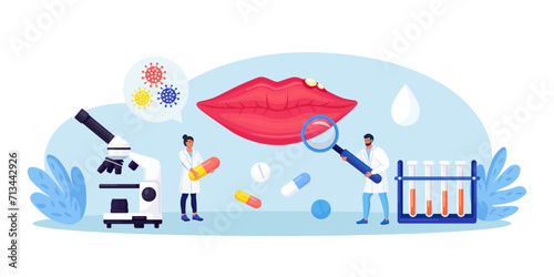 Herpes simplex virus on human lips. Dermatological disease with watery blisters in the skin. STD infection. Doctors diagnosis HSV virus. Clinical exam, visual inspection, laboratory tests