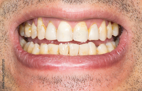 Close-up front view examination of an unrecognizable man mouth open with yellowish teeth colored spots because of smoking and bad hygiene, resin composite restorations. Beard hair and lips. 