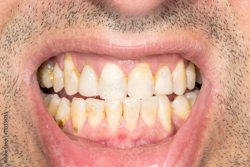 Close-up front view examination of a man mouth open with yellowish biting teeth colored spots because of smoking and bad hygiene, resin composite restorations. Beard hair and lower lip retracted. 