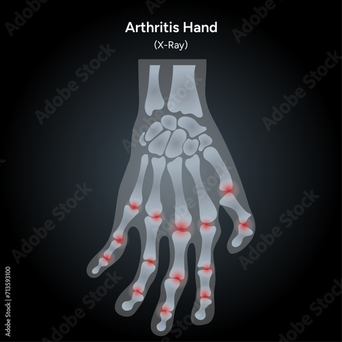Rheumatoid arthritis human hand xray