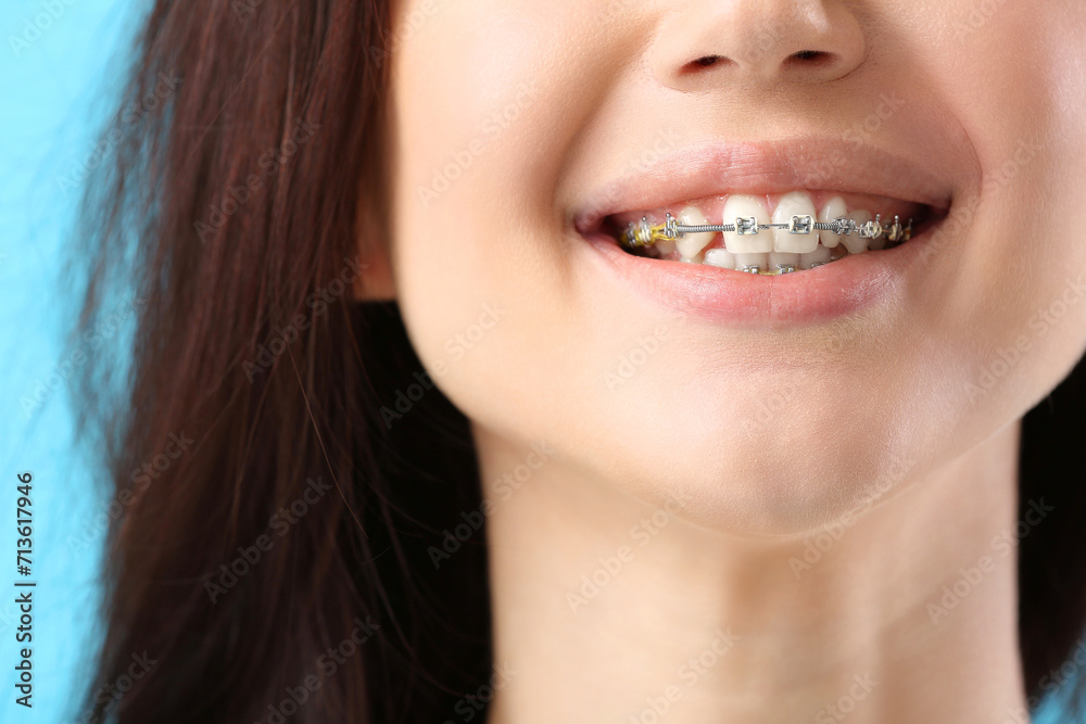 Young woman with dental braces on blue background, closeup Young woman with dental braces on blue background, closeup